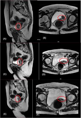 Case report: Gemcitabine intravesical hyperthermic infusion combined with tislelizumab in muscle invasive bladder urothelium carcinoma